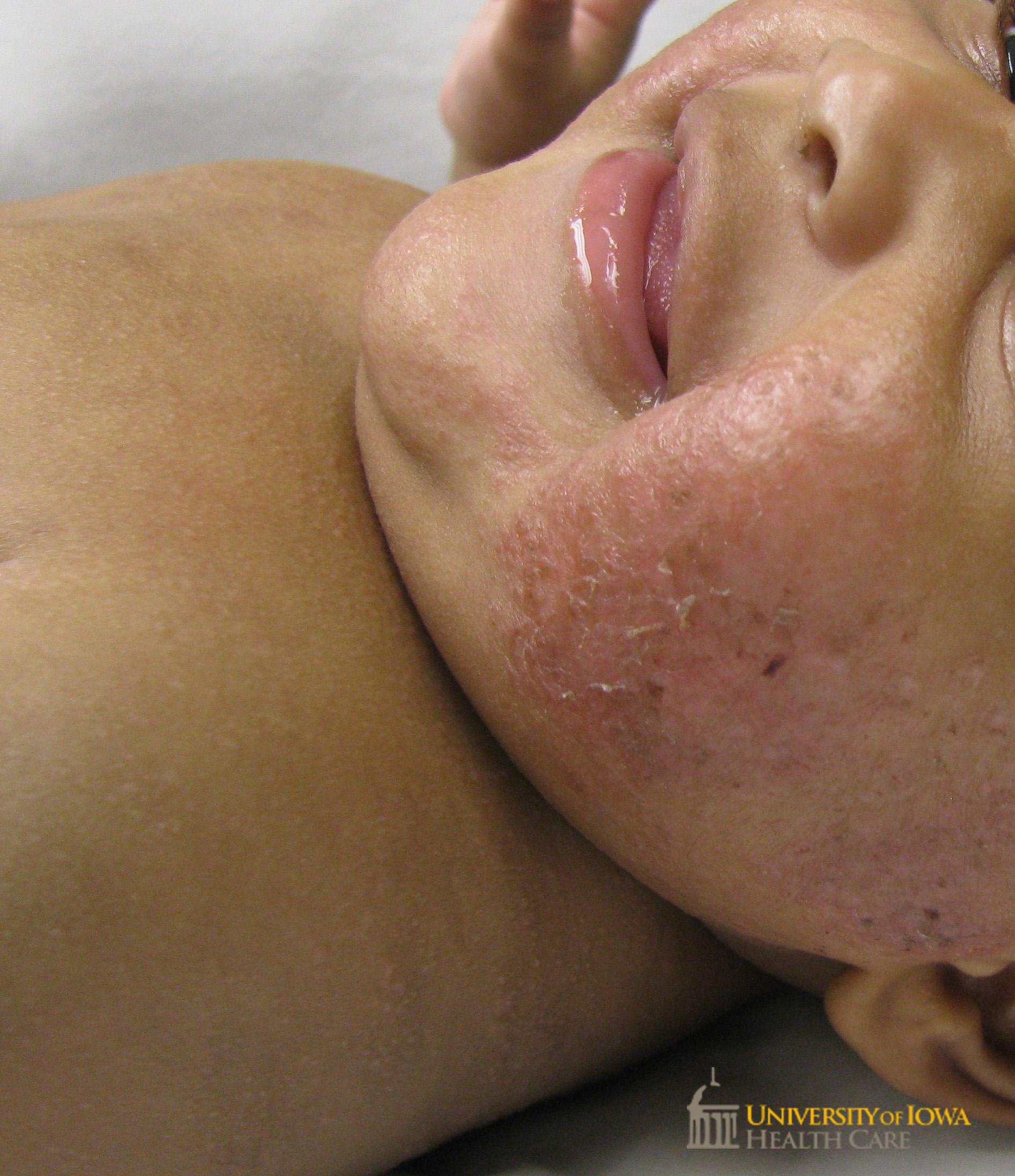 Erythematous scaly plaques on the cheeks. (click images for higher resolution).